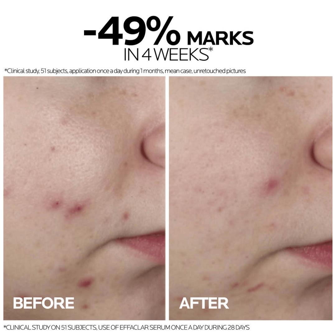 La Roche-Posay Effaclar Ultra Concentrated Serum – 30ml